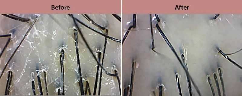 Close-up of hair and scalp before and after treatment comparison under a microscope.