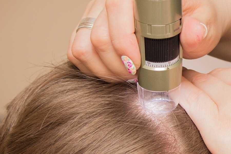 A hand using a dermatoscope to examine the scalp of a person with light brown hair.
